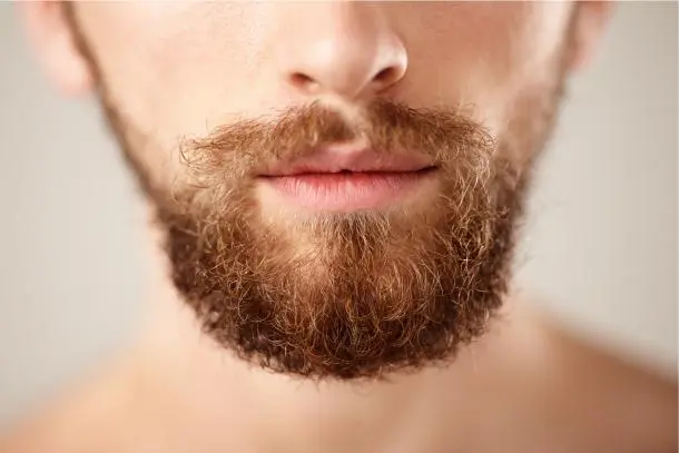 Joven pelirrojo con implante de barba después de 1 año