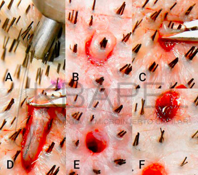 Tricoscopia con aumento de 35x de la extracción de UF: A) colocación del punch en la UF, 