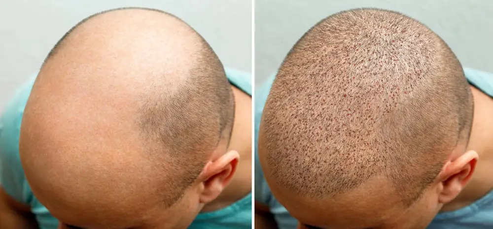 Pros y contras de los trasplantes de cabello o Injerto Capilar