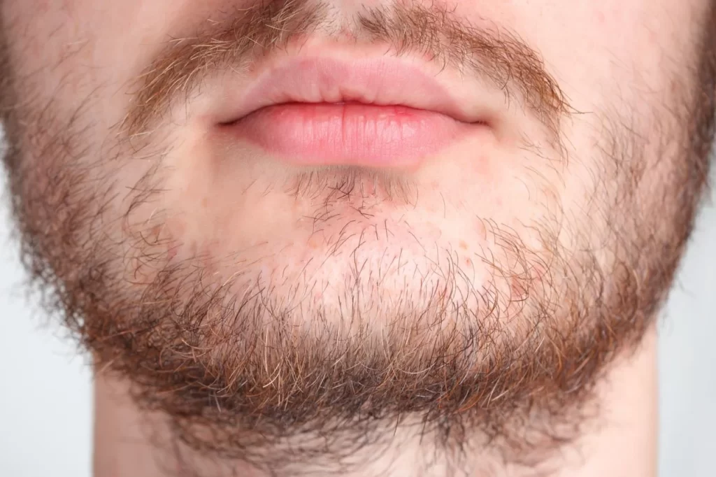 Paciente con barba incompleta
