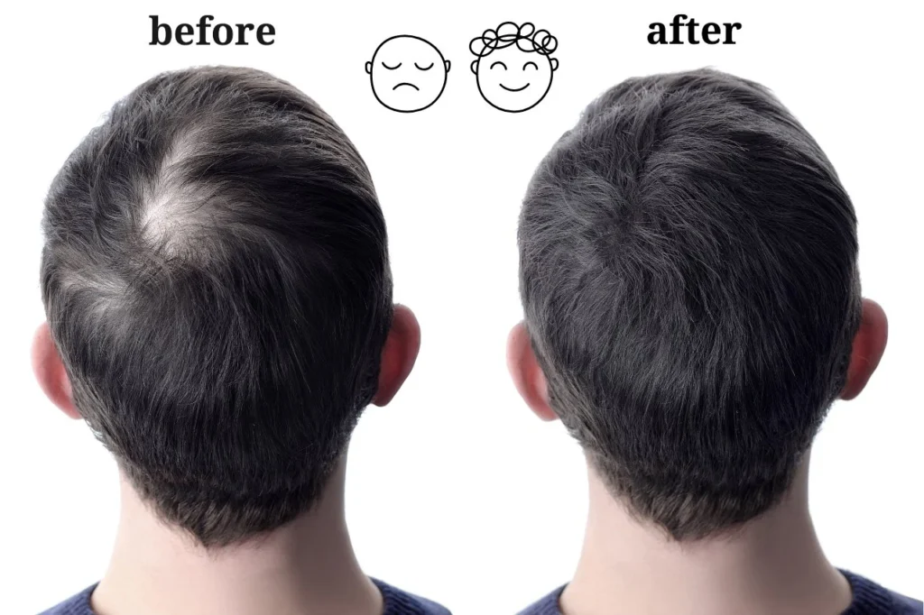 Hair Transplant Before and After | Mexico City